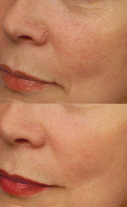 Schoonheidssalon De Ratelaar Couperose